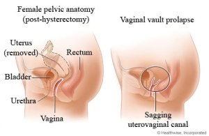 Vaginal prolapse
